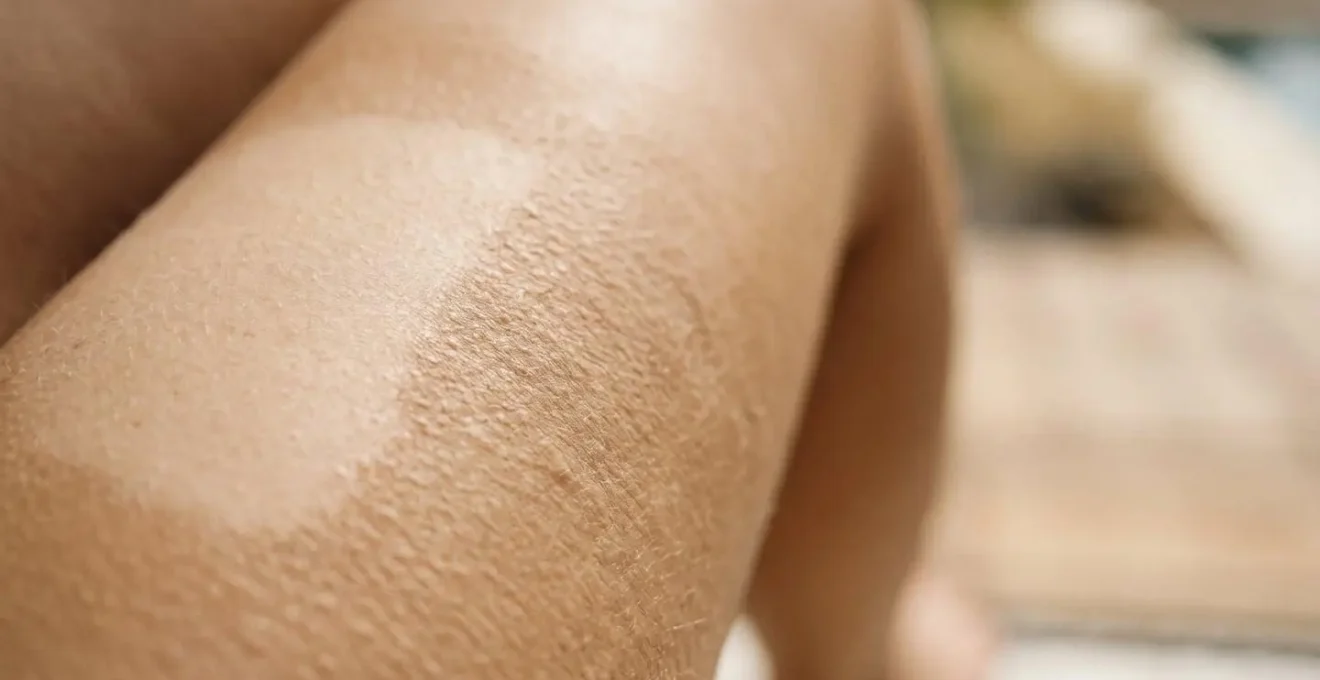 Pelle delle gambe con texture ruvida che impedisce una abbronzatura uniforme in estate