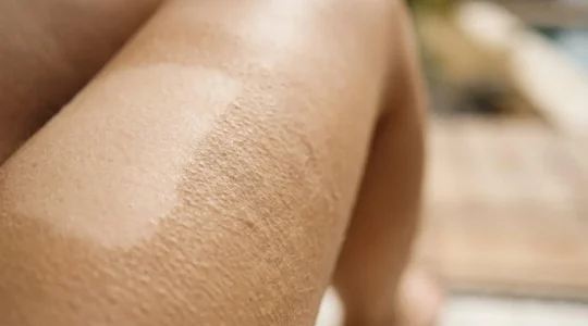 Pelle delle gambe con texture ruvida che impedisce una abbronzatura uniforme in estate