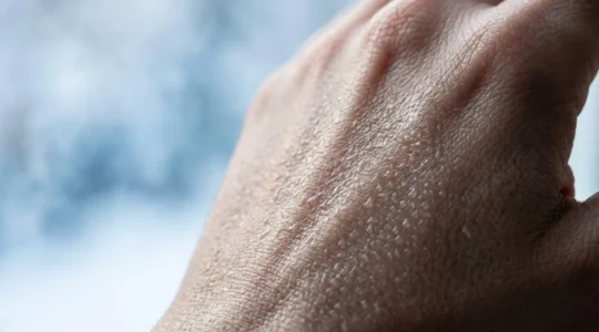 Pelle sana con barriera lipidica protettiva durante l'inverno per dermatite atopica